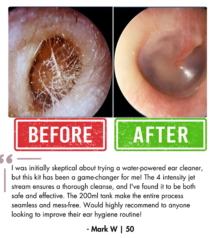 ENT-Approved Home Ear Irrigation Micro-Clinic System – German-Engineered Vortex Pulse Wax Removal Kit Compliant with AAO-HNS Guidelines (Save $1400+ on Clinic Visits!) - detail 12