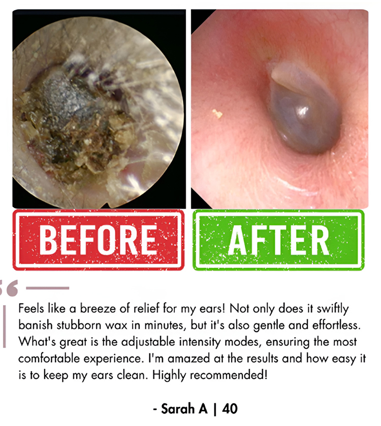 ENT-Approved Home Ear Irrigation Micro-Clinic System – German-Engineered Vortex Pulse Wax Removal Kit Compliant with AAO-HNS Guidelines (Save $1400+ on Clinic Visits!) - detail 13